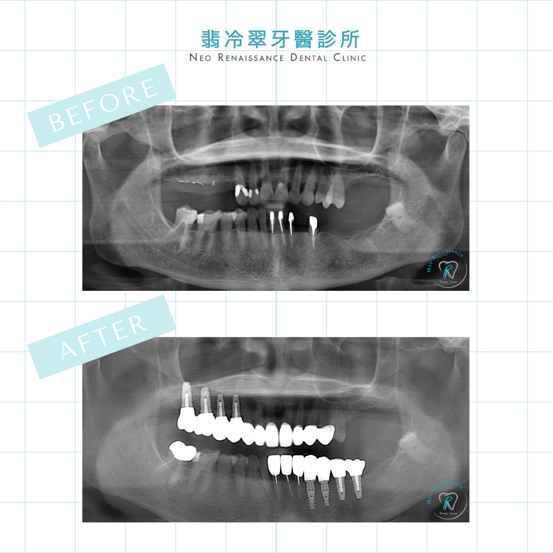 前牙全瓷冠假牙重建