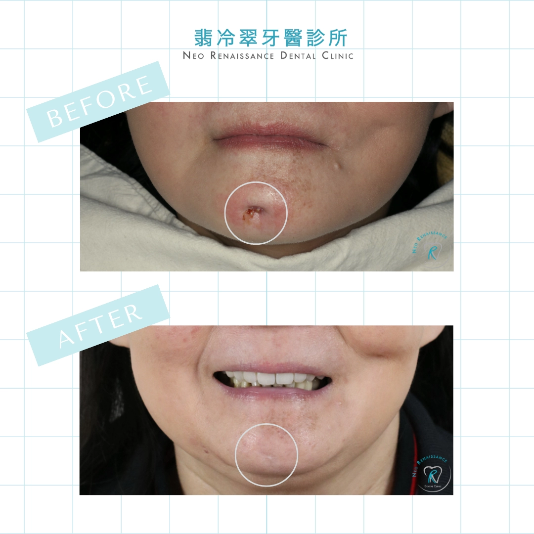 前牙全瓷冠假牙重建