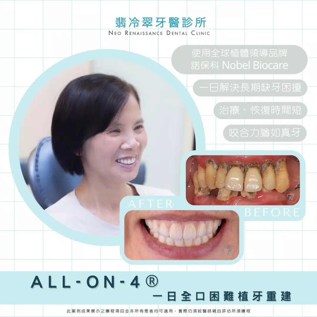 ◆ All-On-4 全口植牙重建案例