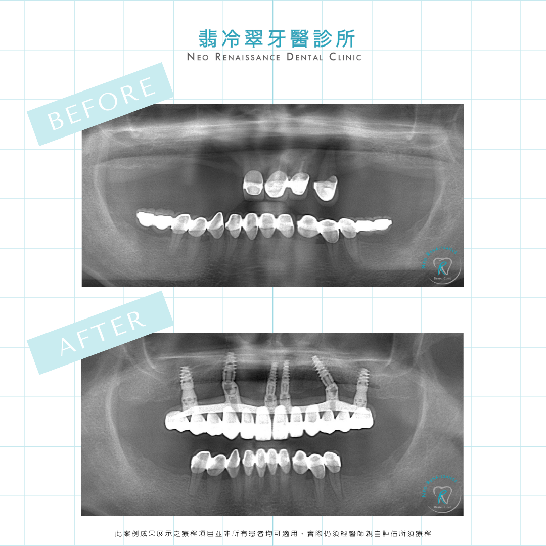 ALL-ON-4®一日全口植牙重建-賴先生