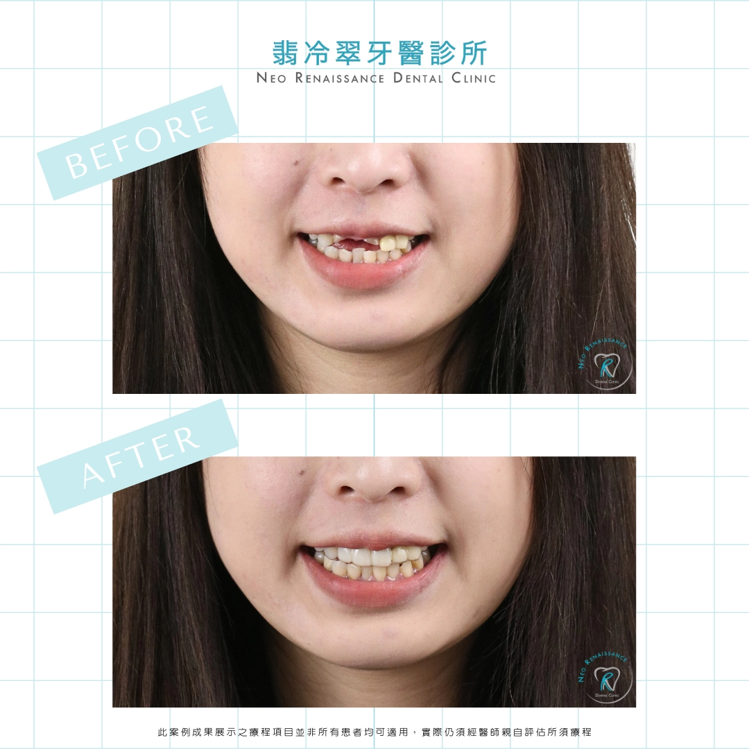 前牙重建-陳小姐