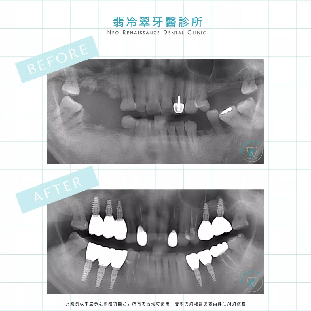 全口植牙重建-許先生