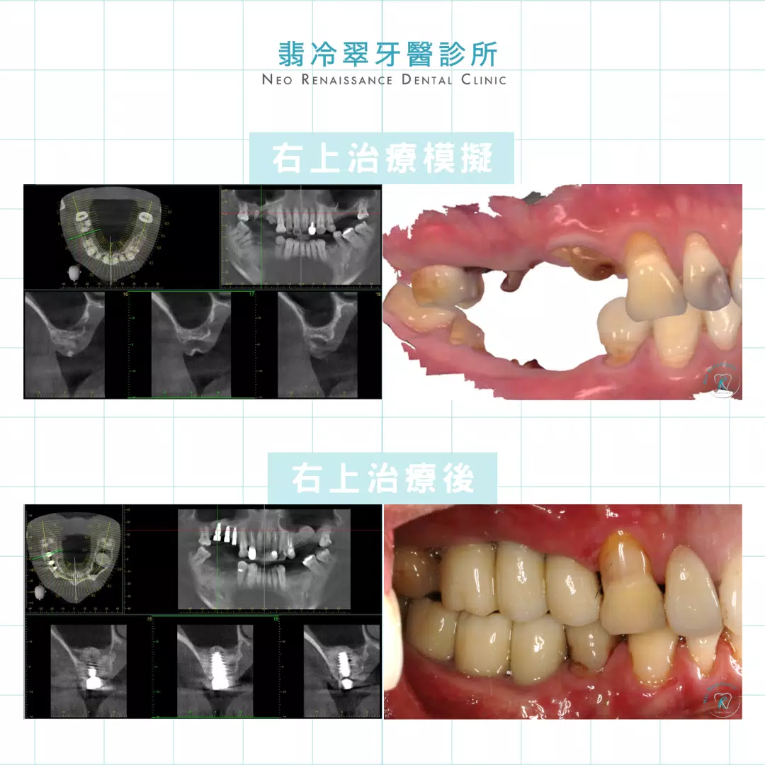 全口植牙重建-許先生