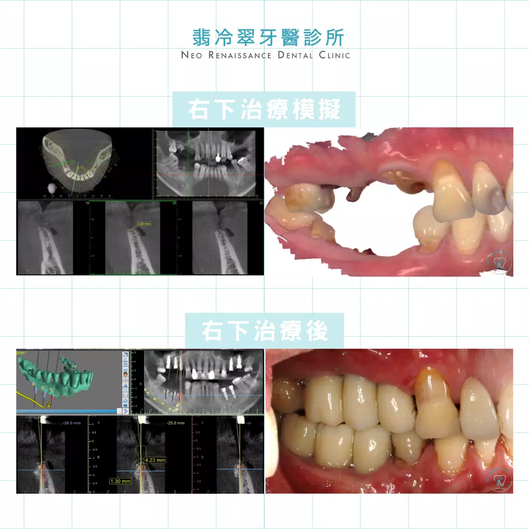 全口植牙重建-許先生