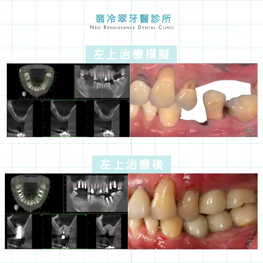 全口植牙重建-許先生