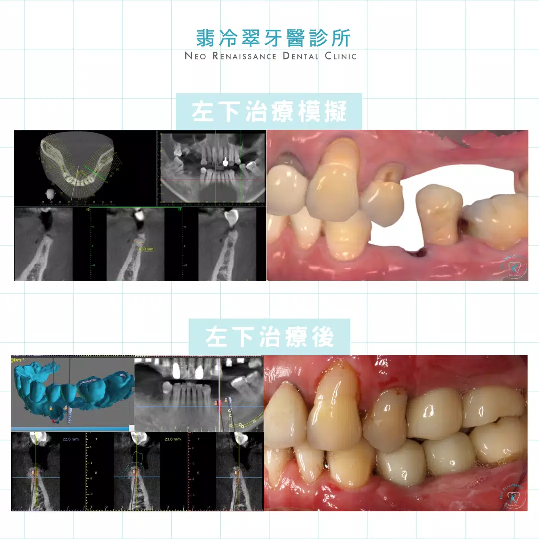 全口植牙重建-許先生