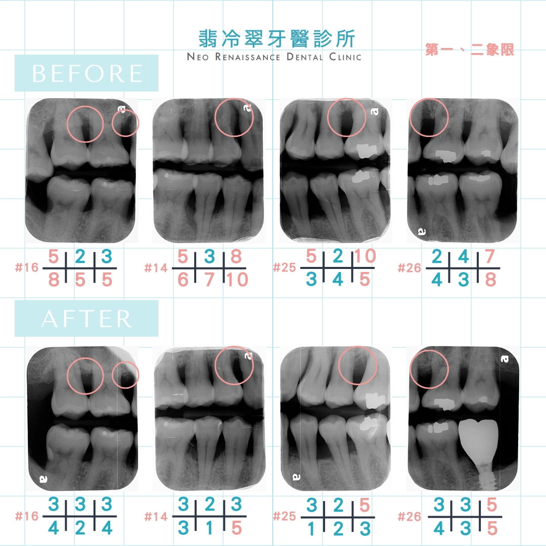 水雷射牙周病、補骨治療