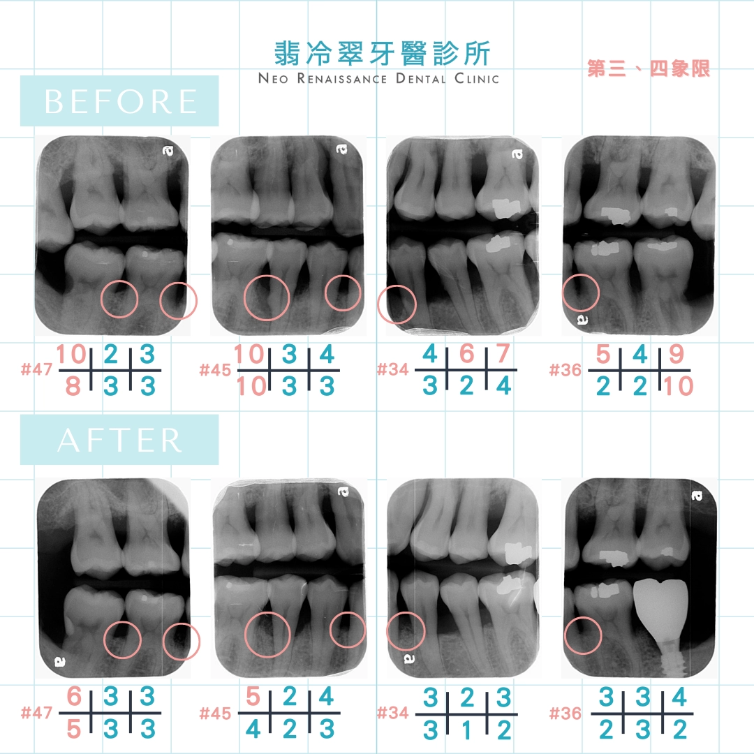 水雷射牙周病、補骨治療