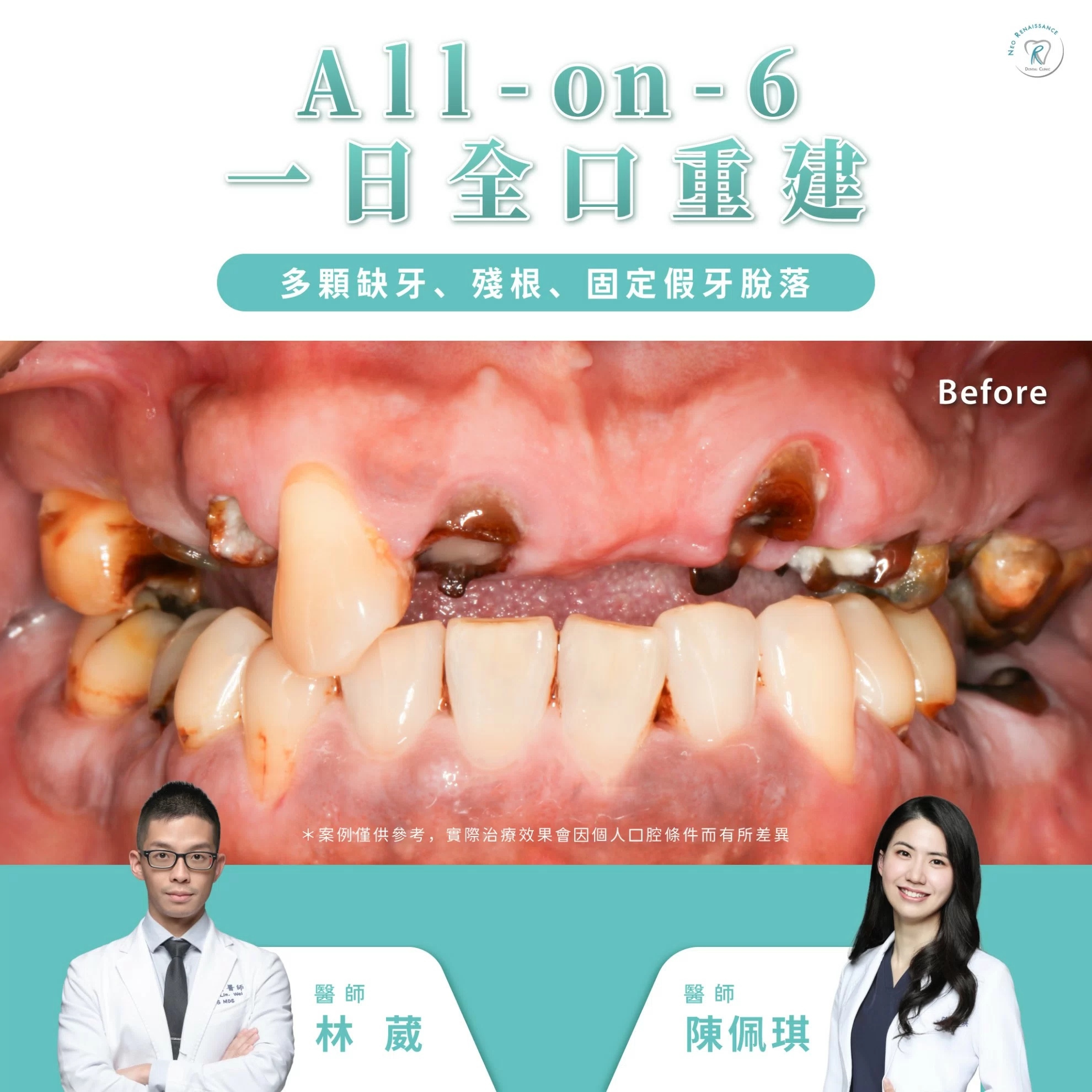 ALL-ON-6 一日全口重建