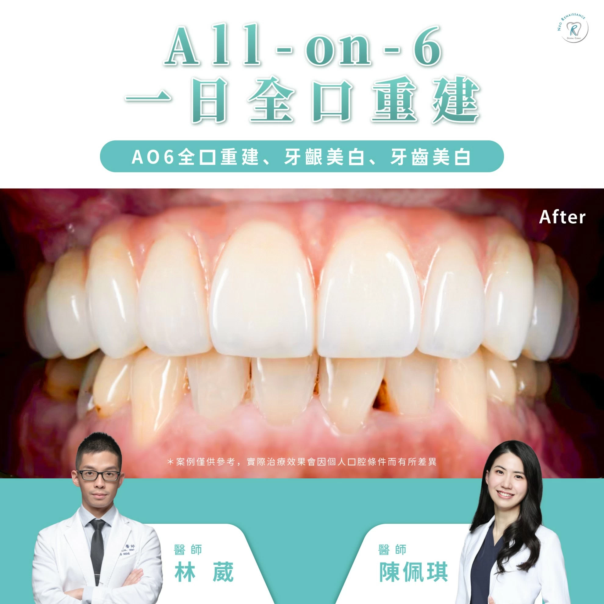 ALL-ON-6 一日全口重建