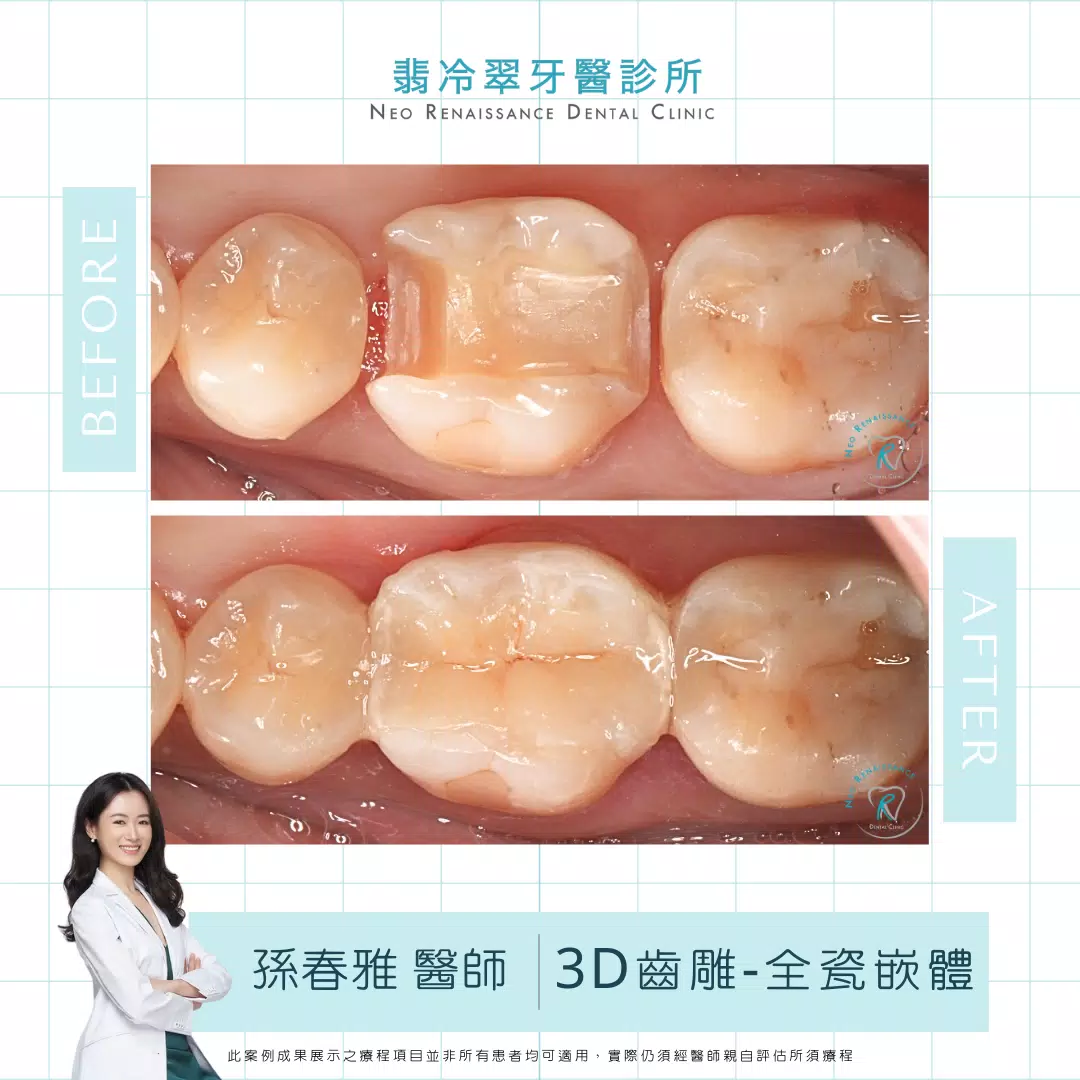 3D齒雕-全瓷嵌體