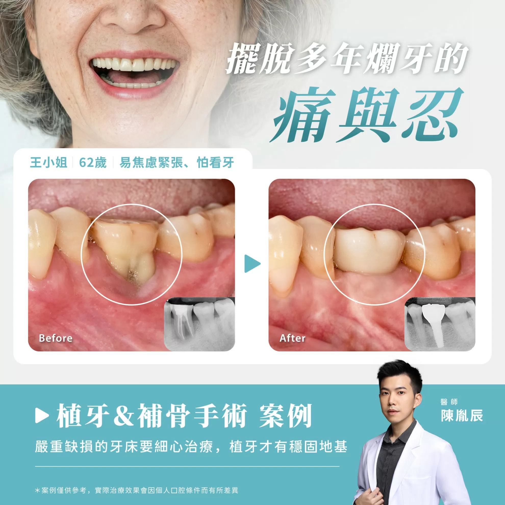 植牙案例分享
