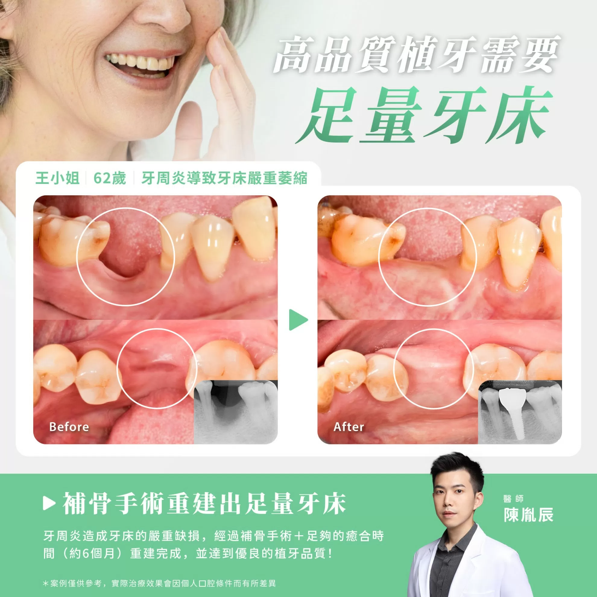補骨+植牙案例分享 補骨+植牙案例分享