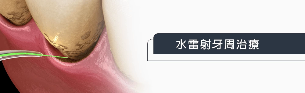 水雷射牙周治療 水雷射牙周治療