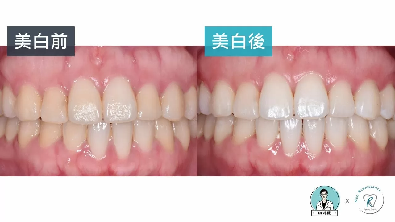 牙齒美白大解密 牙齒美白大解密